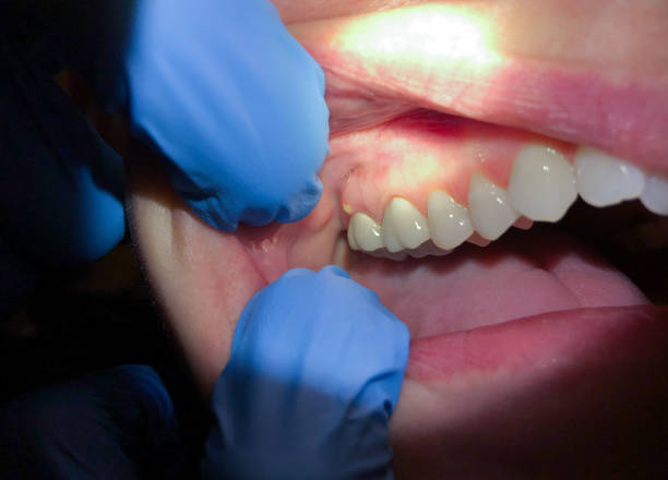 Best Emergency Wisdom Tooth Extraction in Grandview, TX