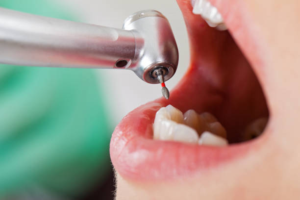Best Knocked-Out Tooth (Avulsed Tooth) Treatment in Grandview, TX